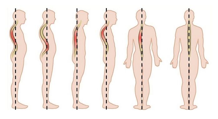 Les troubles posturaux comme cause d'ostéochondrose thoracique