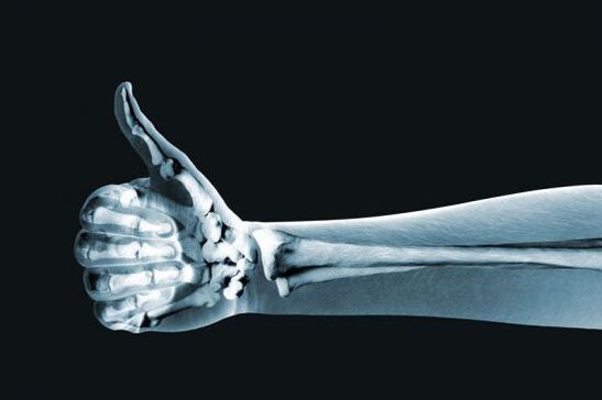 Les radiographies peuvent être utiles pour diagnostiquer la douleur dans les articulations des doigts