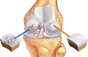 Causes de l'arthrose de l'articulation du genou
